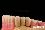 Stainless Steel Prostheses Partial Dentures Attachments Polished Surface Ball