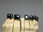 ODM Dental Prosthesis Crown Telescope Precision Attachment Denture